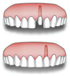 Ricostruzione dente singolo