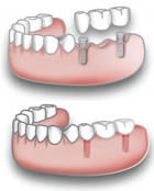 Ricostruzione di più elementi dentali