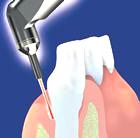 Laser gengivale dentali