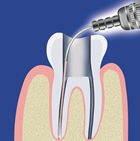 Laser Infezioni dentali